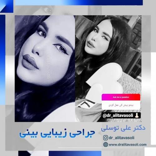 جراحی-بینی-242