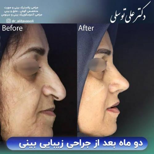 جراحی-بینی-344