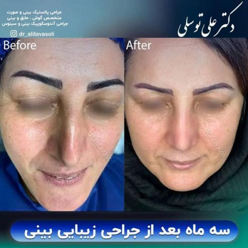 جراحی-بینی-346