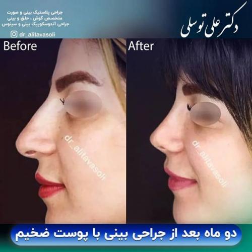 جراحی-بینی-349