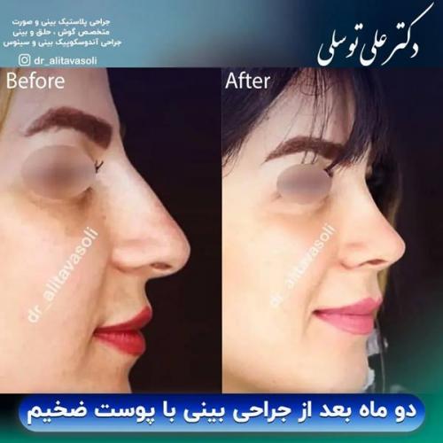 جراحی-بینی-350
