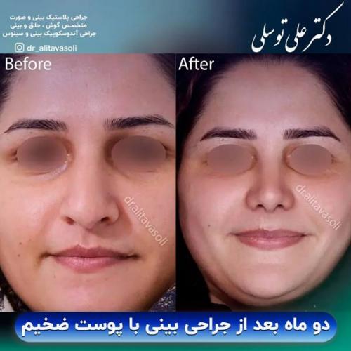 جراحی-بینی-351
