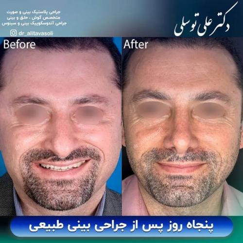 جراحی-بینی-355