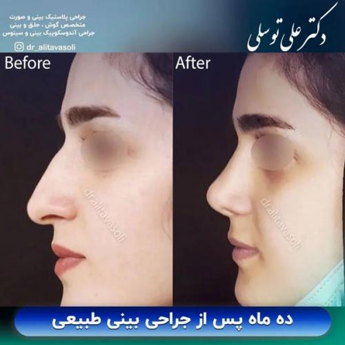 جراحی-بینی-358 (1)