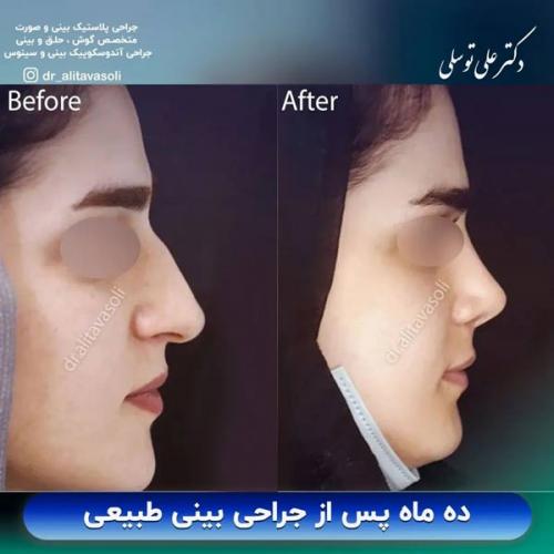 جراحی-بینی-359 (1)