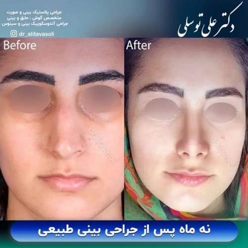 جراحی-بینی-360 (1) (1) (1)