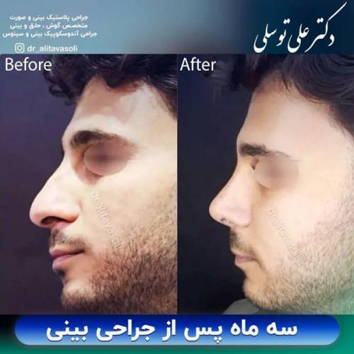 جراحی-بینی-368 (1)