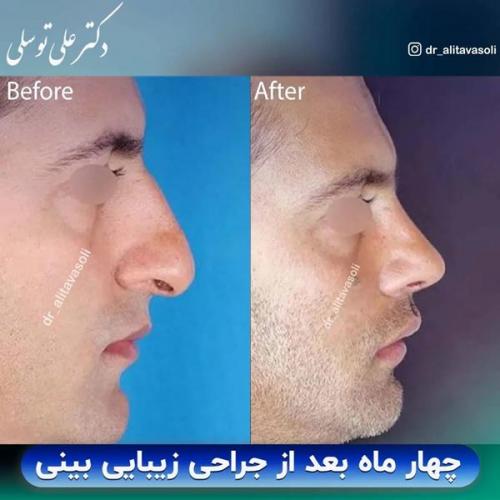 جراحی-بینی-393