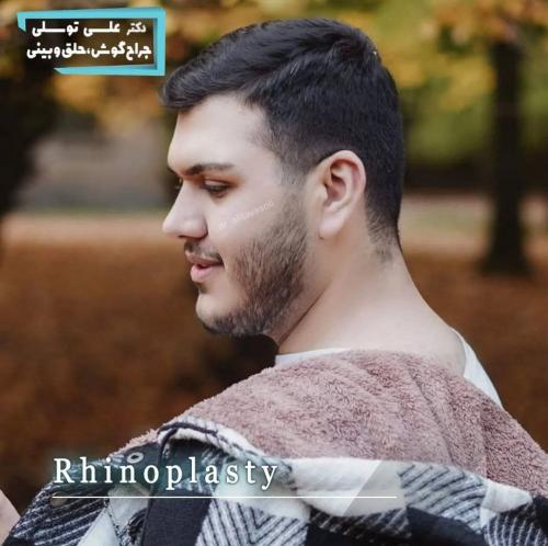 جراحی-بینی-473