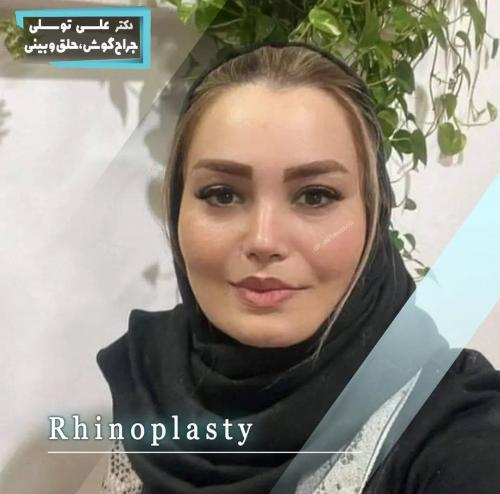 جراحی-بینی-474