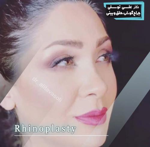جراحی-بینی-475