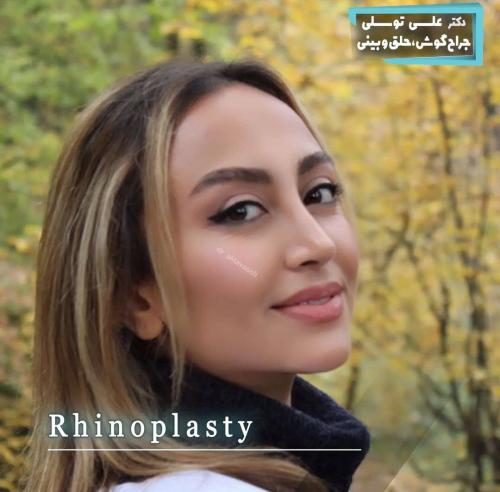 جراحی-بینی-477