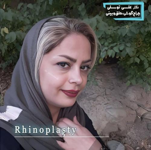 جراحی-بینی-478