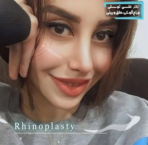 جراحی-بینی-479