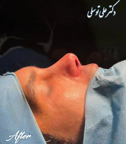 جراحی-بینی-482