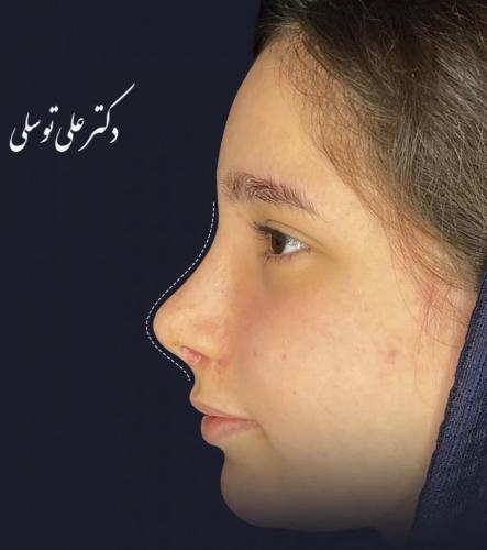 جراحی-بینی-483