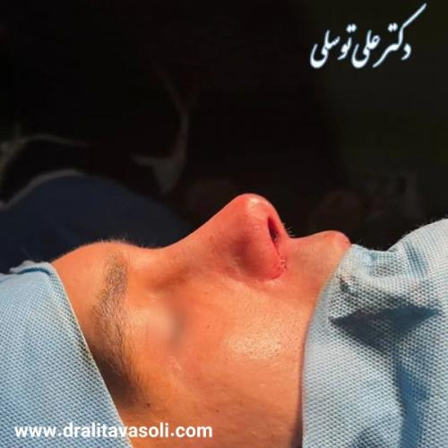 جراحی-بینی-485