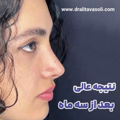 جراحی-بینی-486
