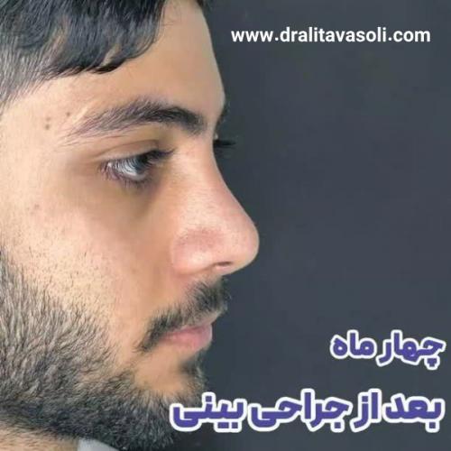 جراحی-بینی-487