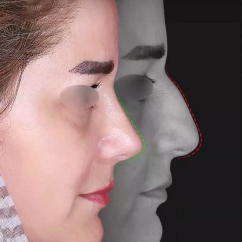 جراحی-بینی-490