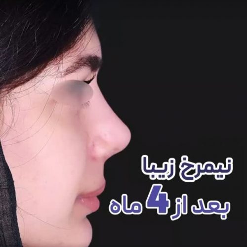جراحی-بینی-492