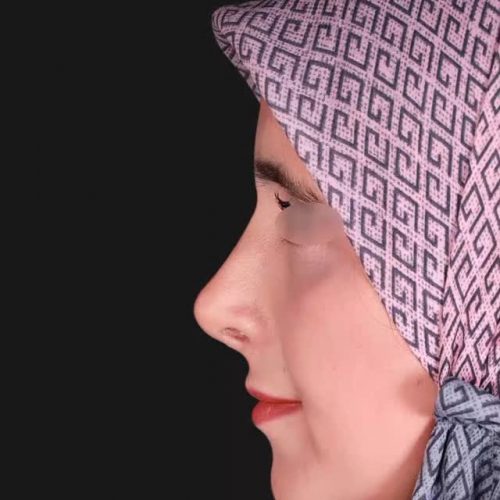 جراحی-بینی-494