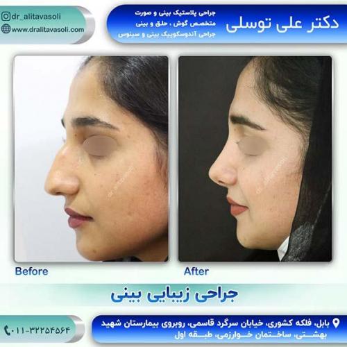 جراحی-بینی-55