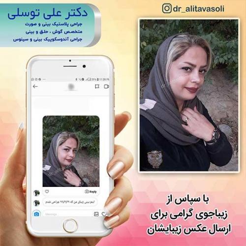 جراحی-بینی-60