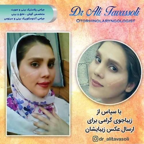 جراحی-بینی-61