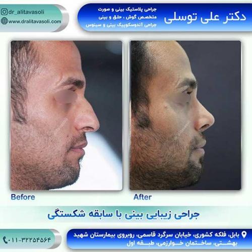 جراحی-بینی-70