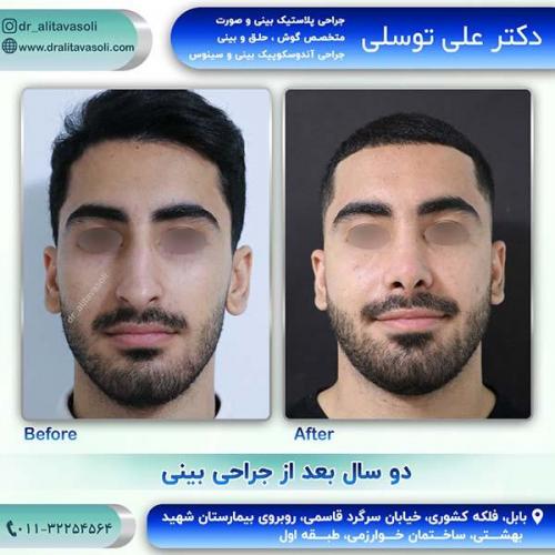 جراحی-بینی-77