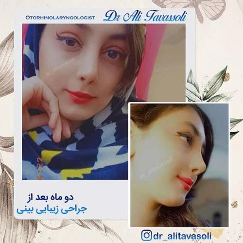 جراحی-بینی-81