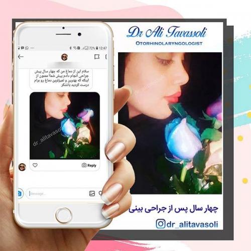 جراحی-بینی-84