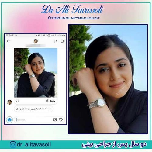 جراحی-بینی-89
