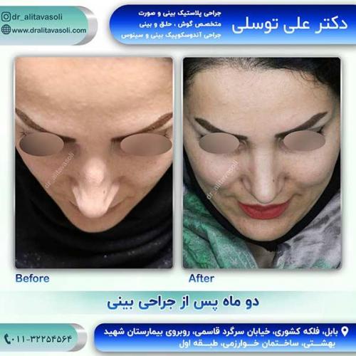 جراحی-بینی-92