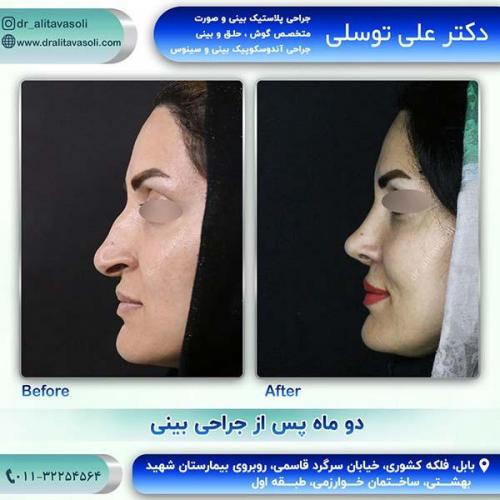 جراحی-بینی-93