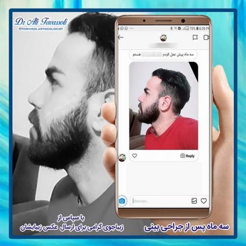 جراحی-بینی-95