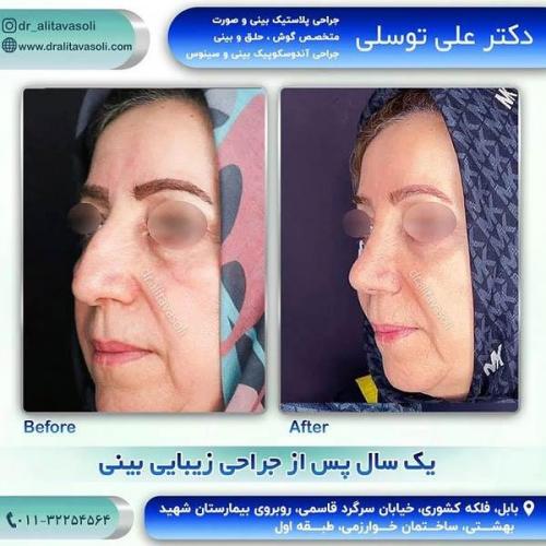 جراحی-بینی244