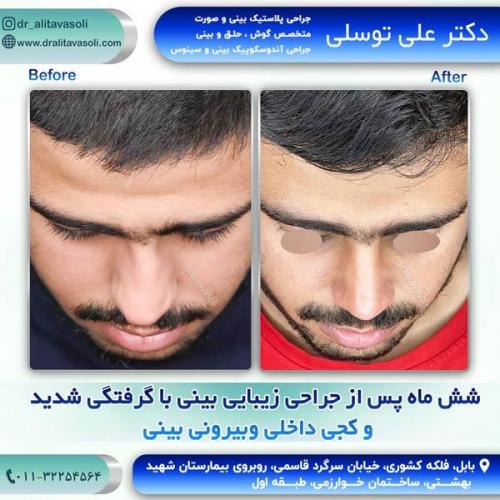 جراحی-بینی250