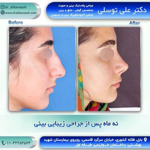 جراحی-بینی258