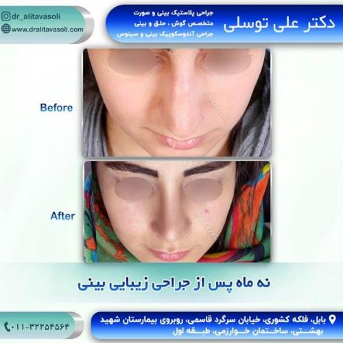 جراحی-بینی259