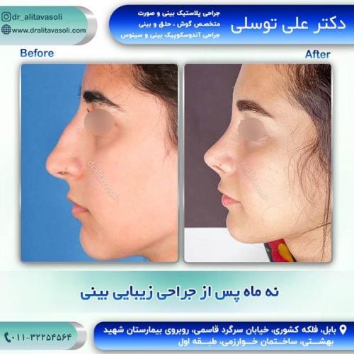 جراحی-بینی260