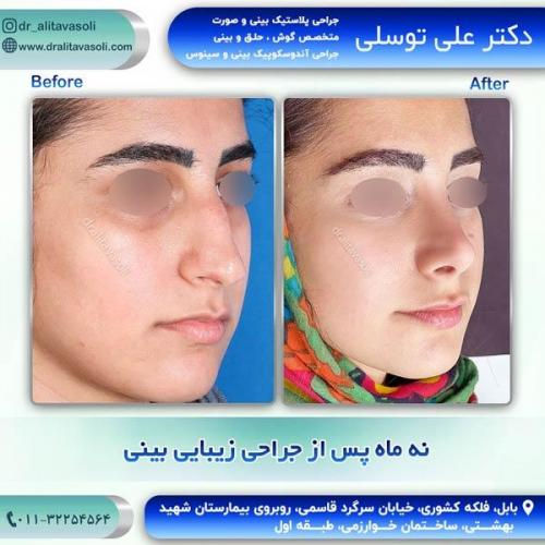 جراحی-بینی261