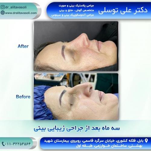 جراحی-بینی274
