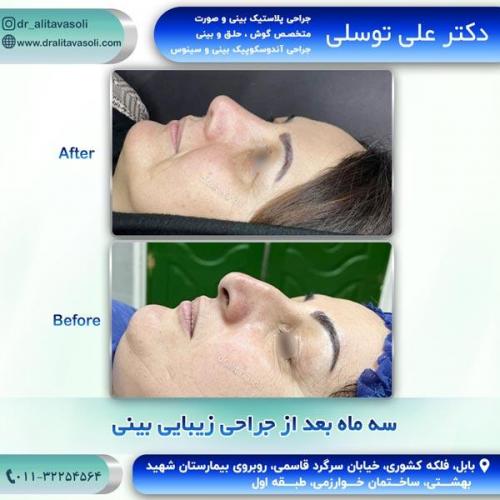 جراحی-بینی275