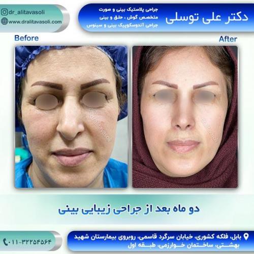 جراحی-بینی277