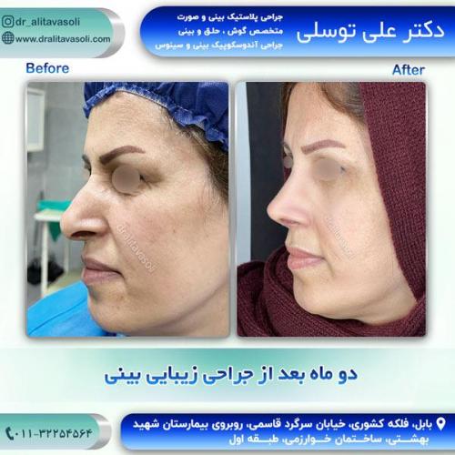 جراحی-بینی278
