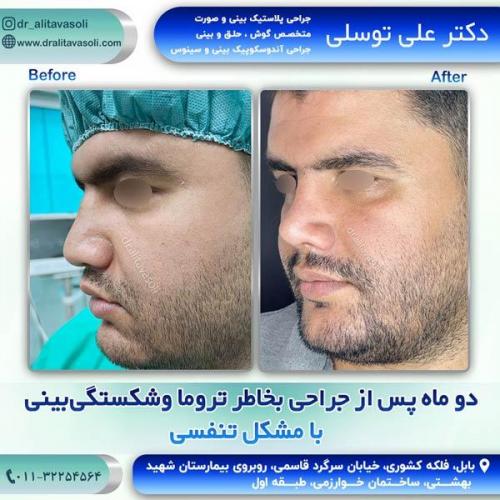 جراحی-بینی288