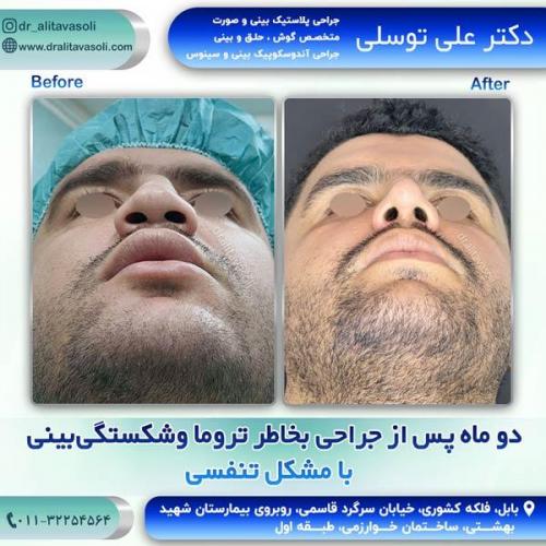 جراحی-بینی289
