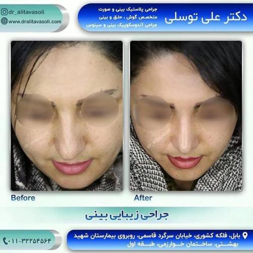 جراحی-بینی311-